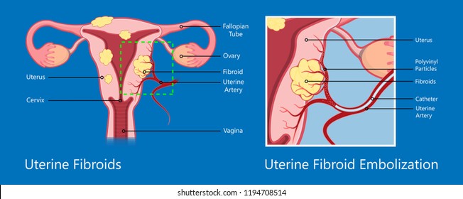 laparoscopic hysterectomy medical surgical treat cervix ovary subtotal minimally invasive procedure MIP Open UFE tumor agents diagnosis UAE guided Focused Ultrasound pcos syndrome cysts pmdd type