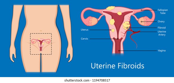 laparoscopic hysterectomy medical surgical treat cervix ovary subtotal minimally invasive procedure MIP Open UFE tumor agents diagnosis UAE guided Focused Ultrasound pcos syndrome cysts pmdd type