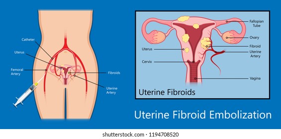 laparoscopic hysterectomy medical surgical treat cervix ovary subtotal minimally invasive procedure MIP Open UFE tumor agents diagnosis UAE guided Focused Ultrasound pcos syndrome cysts pmdd type