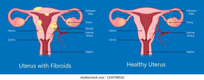 laparoscopic hysterectomy medical surgical treat cervix ovary subtotal minimally invasive procedure MIP Open UFE tumor agents diagnosis UAE guided Focused Ultrasound pcos syndrome cysts pmdd type