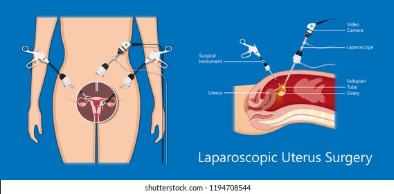 laparoscopic hysterectomy medical surgical treat cervix ovary subtotal minimally invasive procedure MIP Open UFE tumor agents diagnosis UAE guided Focused Ultrasound pcos syndrome cysts pmdd type