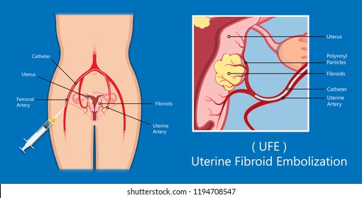 laparoscopic hysterectomy medical surgical treat cervix ovary subtotal minimally invasive procedure MIP Open UFE tumor agents diagnosis UAE guided Focused Ultrasound pcos syndrome cysts pmdd type