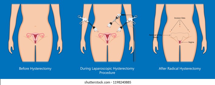 laparoscopic hysterectomy medical surgical treat cervix ovary subtotal minimally invasive procedure MIP Open UFE tumor agents diagnosis UAE guided Focused Ultrasound pcos syndrome cysts pmdd type