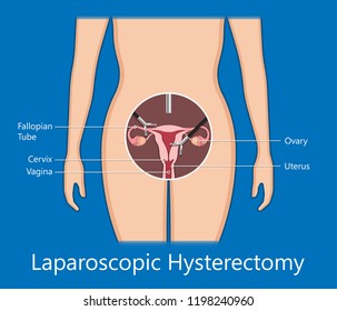 Laparoscopic Hysterectomy Medical Surgical Treat Cervix Stock Vector