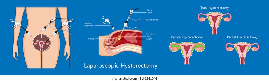 laparoscopic hysterectomy medical surgical treat cervix ovary subtotal minimally invasive procedure MIP Open UFE tumor agents diagnosis UAE guided Focused Ultrasound pcos syndrome cysts pmdd type