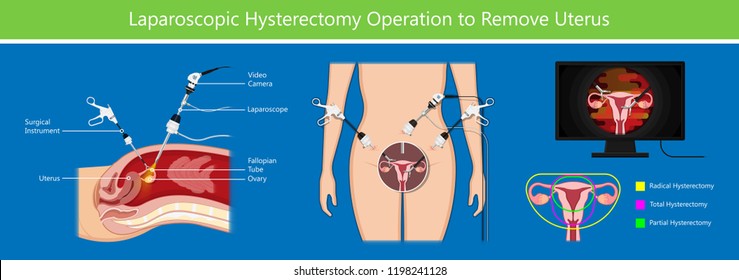 laparoscopic hysterectomy medical surgical treat cervix ovary subtotal minimally invasive procedure MIP Open UFE tumor agents diagnosis UAE guided Focused Ultrasound pcos syndrome cysts pmdd type