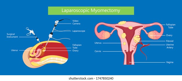 Laparoscopic myomectomy recovery stories