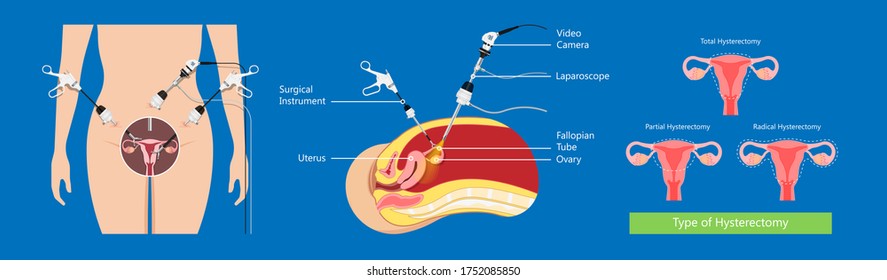 laparoscopic hysterectomy medical surgical treat cervix ovary subtotal minimally invasive procedure MIP Open UFE tumor agents diagnosis UAE guided Focused Ultrasound pcos syndrome cysts pmdd type