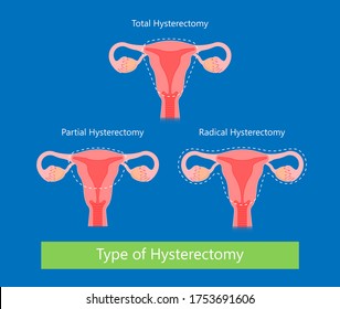 laparoscopic hysterectomy medical surgical treat cervix ovary subtotal minimally invasive procedure MIP Open UFE tumor agents diagnosis UAE guided Focused Ultrasound pcos syndrome cysts pmdd type