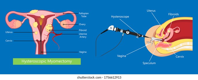 laparoscopic hysterectomy medical surgical treat cervix ovary subtotal minimally invasive procedure MIP Open UFE tumor agents diagnosis UAE guided Focused Ultrasound pcos syndrome cysts pmdd type