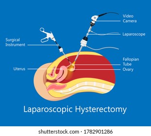 laparoscopic hysterectomy medical surgical treat cervix ovary subtotal minimally invasive procedure MIP Open UFE tumor agents diagnosis UAE guided Focused Ultrasound pcos syndrome cysts pmdd type