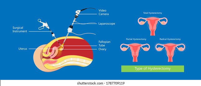 laparoscopic hysterectomy medical surgical treat cervix ovary subtotal minimally invasive procedure MIP Open UFE tumor agents diagnosis UAE guided Focused Ultrasound pcos syndrome cysts pmdd type