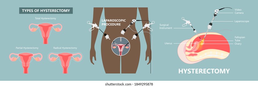 laparoscopic hysterectomy medical surgical treat cervix ovary subtotal minimally invasive procedure MIP Open UFE tumor agents diagnosis UAE guided Focused Ultrasound pcos syndrome cysts pmdd type