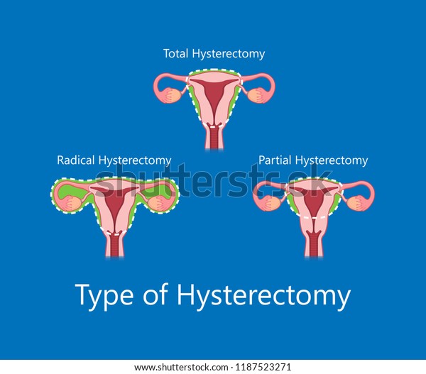 Laparoscopic Hysterectomy Medical Surgical Treat Cervix Stock Vector Royalty Free 1187523271 7301