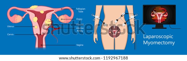 Laparoscopic Hysterectomy Medical Surgical Treat Cervix เวกเตอร์สต็อก ปลอดค่าลิขสิทธิ์ 6274