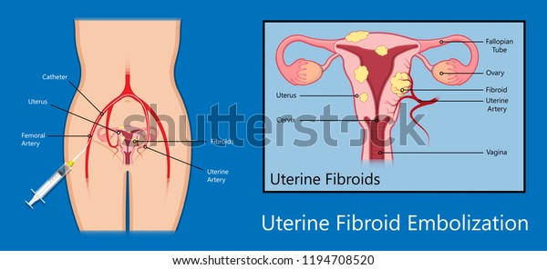 Laparoscopic Hysterectomy Medical Surgical Treat Cervix Image Vectorielle De Stock Libre De 3257