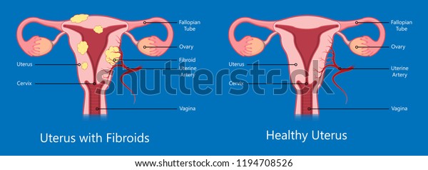 Laparoscopic Hysterectomy Medical Surgical Treat Cervix Stock Vector ...