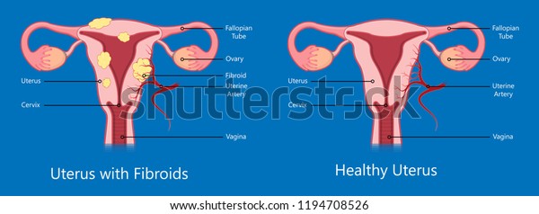 Laparoscopic Hysterectomy Medical Surgical Treat Cervix Stock Vector Royalty Free 1194708526 9529