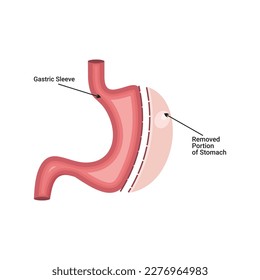 Laparoscopic Sleeve Gastrectomy simple vector 