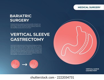 Laparoskopische Schläfrigkeit Gastrektomie, Vertikale Gastrektomie, Körperverlustoperation Vektorgrafik einer Operation zur Reduktion der Magenreduktion
