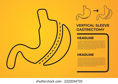 Laparoscopic Sleeve Gastrectomy, Vertical Gastrectomy, Weight loss surgery Vector Illustration of Stomach reduction surgery
