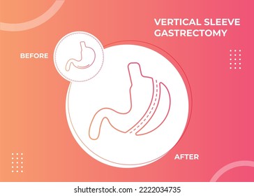 Laparoscopic Sleeve Gastrectomy, Vertical Gastrectomy, Weight loss surgery Vector Illustration of Stomach reduction surgery
