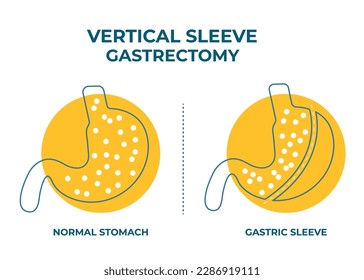 Gastrectomía de manga laparoscópica, Gastrectomía vertical, cirugía de pérdida de peso Vector Ilustración de cirugía de reducción de Stomach
