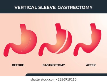 Gastrectomía de manga laparoscópica, Gastrectomía vertical, cirugía de pérdida de peso Vector Ilustración de cirugía de reducción de Stomach
