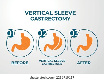 Gastrectomía de manga laparoscópica, Gastrectomía vertical, cirugía de pérdida de peso Vector Ilustración de cirugía de reducción de Stomach
