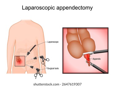 Cirurgia laparoscópica. Apendicite para remover um apêndice inflamado. Cirurgia minimamente invasiva. Remoção do apêndice. Cartaz Vetor Detalhado