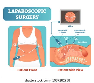 Laparoscopic surgery medical health care surgical procedure process, anatomical cross section vector illustration diagram. Laparoscopy instruments with camera and screen.