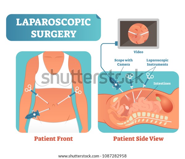 Laparoscopic surgery medical\
health care surgical procedure process, anatomical cross section\
vector illustration diagram. Laparoscopy instruments with camera\
and screen.