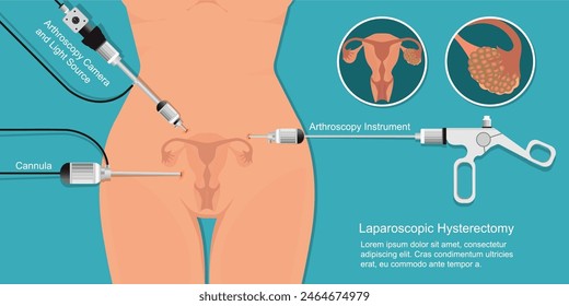 Laparoscopic surgery for treatment fibroids and cysts in the uterus,ovarian cancer, laparoscopic hysterectomy.Minimal invasive surgery was perform,endoscope for surgical treatment.vector illustration.