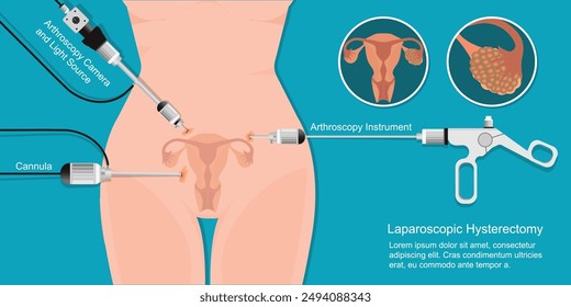 Laparoscopic surgery for treatment fibroids and cysts in the uterus,ovarian cancer, laparoscopic hysterectomy.Minimal invasive surgery was perform,endoscope for surgical treatment.vector illustration.