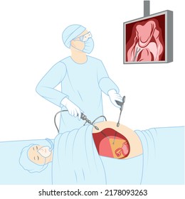 Laparoscopy keyhole surgery doctor with a patient surgical procedure Female Male reproductive system. Medical instruments with camera and screen. Human view in a cut illustration isolated flat icon