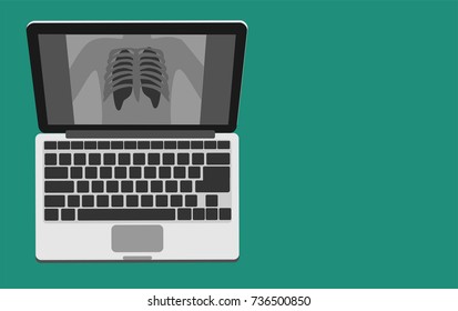 Laptop with view of  chest x-ray isolated on green background. Healthcare and medical concept