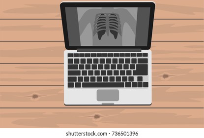 Laptop with view of chest x-ray on wooden table. Healthcare and medical concept