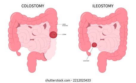 Large Colon removal with stoma Pouch Surgery on abdomen for Small Crohn and Hirschsprung poo stool disease blocked inflammation hernia Cancer tract Rectal system ileum Tumor Loop invasive