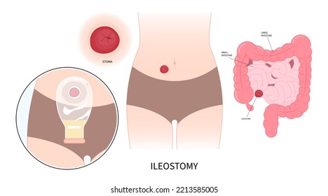 Large Colon removal with stoma Pouch Surgery on abdomen for Small Crohn and Hirschsprung poo stool disease blocked inflammation hernia Cancer tract Rectal system ileum Tumor Loop invasive