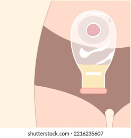 Large Colon removal with stoma Pouch Surgery on abdomen for Small Crohn and Hirschsprung poo stool disease blocked inflammation hernia Cancer tract Rectal system ileum Tumor Loop invasive