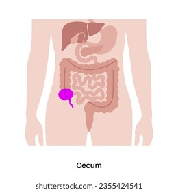 Afiche anatómico intestinal grande. Cecum y apéndice, parte del intestino humano. Examen del tracto digestivo en la clínica de gastroenterología. Infografía de colon para educación, ilustración vectorial aislada