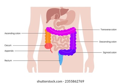 Large intestine anatomical poster. Sections of the human bowel. Digestive tract examination and treatment in gastroenterology clinic. Infographic of colon for education, isolated vector illustration