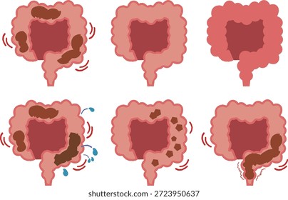 Conjunto de ilustración de intestino Grande, excreción y estreñimiento