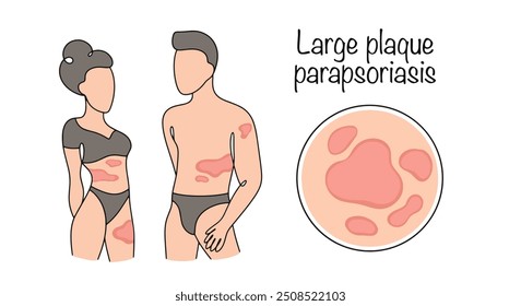 Parapsoríase em placas grandes. Doença cutânea linfoproliferativa inflamatória crônica, manifestada por grandes placas e manchas. Mulher e homem com sintomas da doença. Ilustração vetorial.