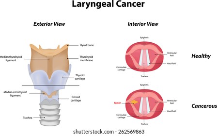 Laryngeal Cancer
