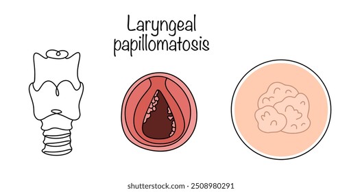 Laryngeal papillomatosis. A benign tumor affecting the respiratory tract. Human larynx with papillomas inside. Color medical illustration on a white background.