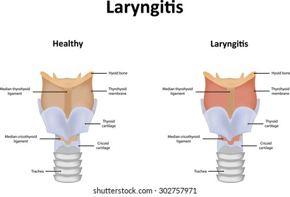 Laryngitis Illustration