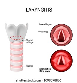 Laryngitis is inflammation of the voice box. normal and Inflamed larynx. Cross section of the voice box. Vocal cords, thyroid cartilage and trachea. vector illustration for medical and educational use