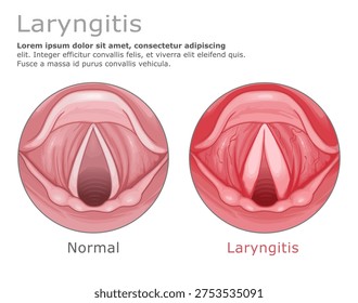 Laryngitis vs normal vocal cords vector medical illustration. ENT Series.