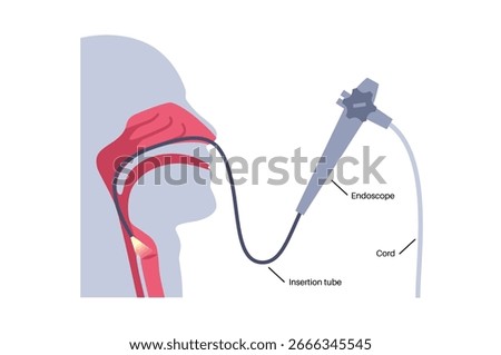 Laryngoscopy medical procedure. Visualization of the larynx and vocal cords using a flexible endoscope. Diagnostic of the airway obstruction, vocal cords and pathologies of the throat evaluation